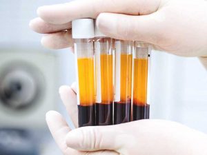 Platelet rich plasma factors