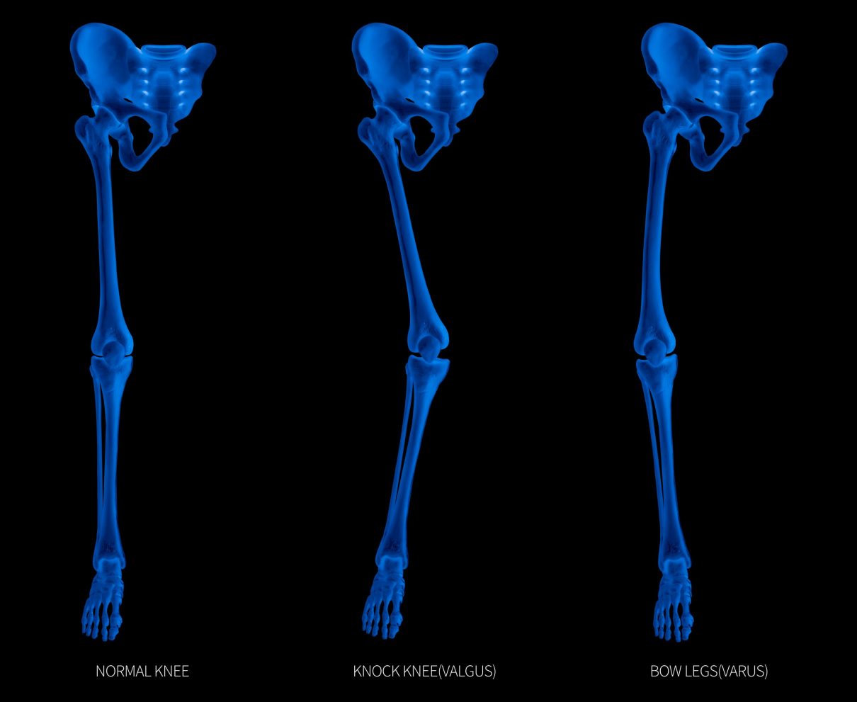 Varus valgus scaled