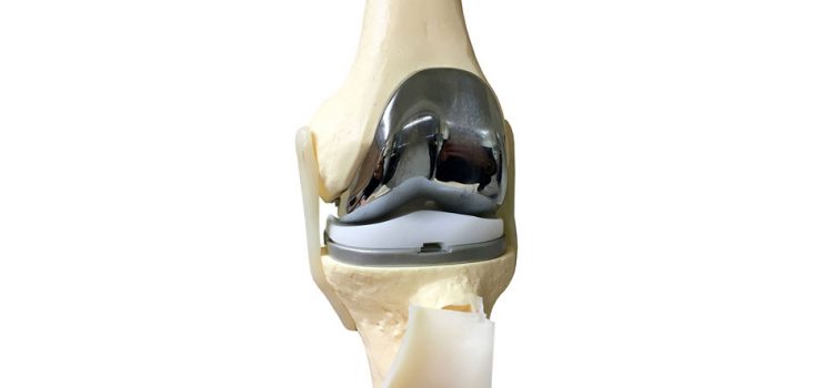 Ρομποτική αρθροπλαστική γόνατος