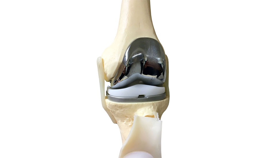 Ρομποτική αρθροπλαστική γόνατος