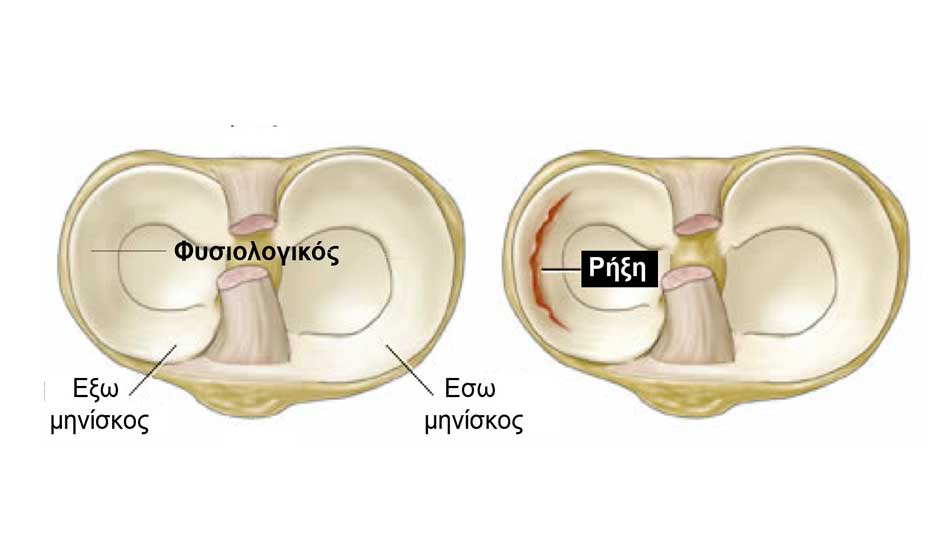 Ρήξη Μηνίσκου