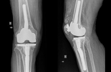 knee ahtroplasty revision