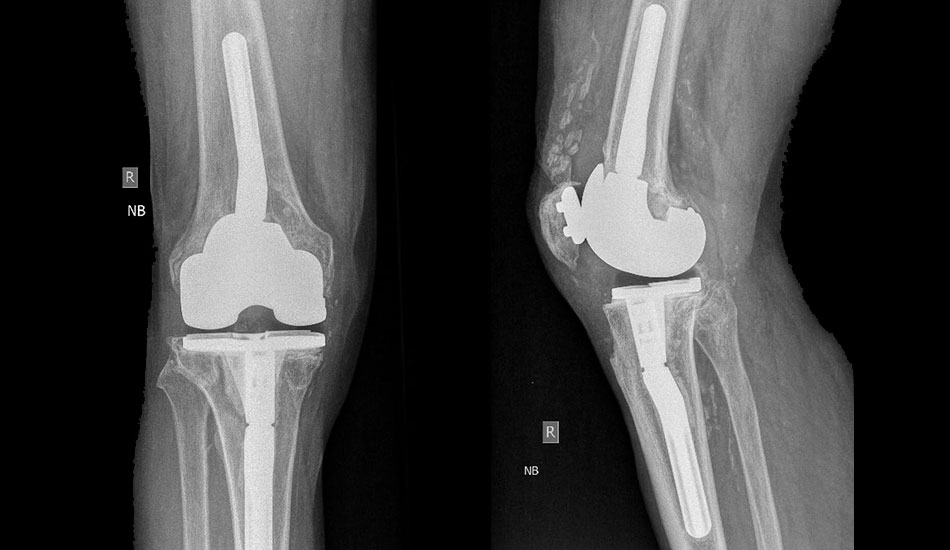 knee ahtroplasty revision