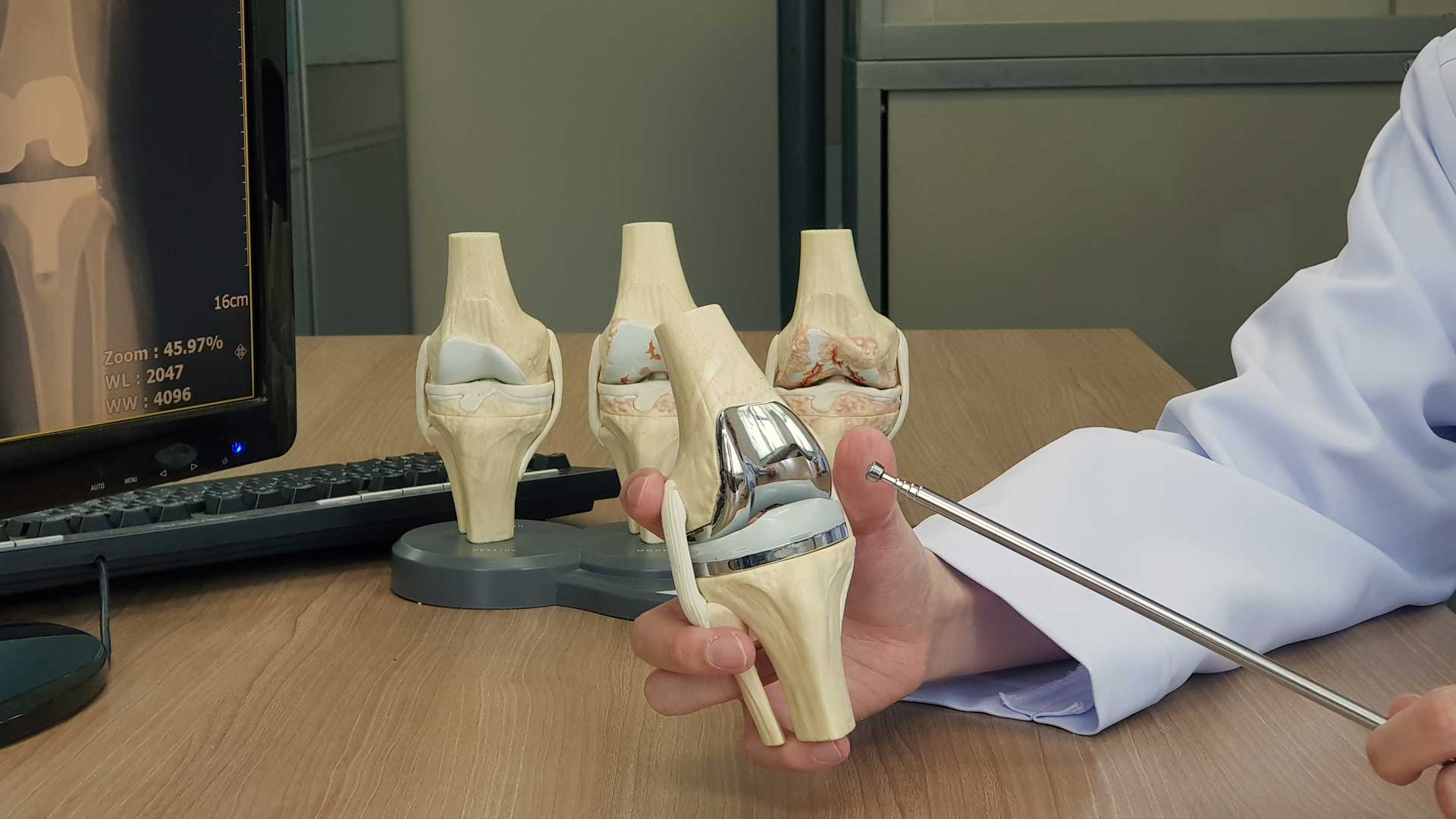 On Average How Long Does A Knee Replacement Last