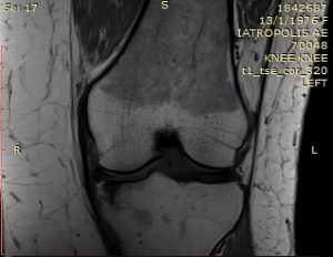 Plastiki-ypochondriou-ostou-subchondroplasty