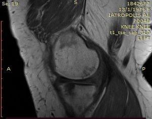 Plastiki-ypochondriou-ostou-subchondroplasty