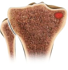 Plastiki-ypochondriou-ostou-subchondroplasty