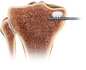 Plastiki-ypochondriou-ostou-subchondroplasty