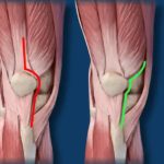 Προσπέλαση υπό τον έσω πλατύ για αρθροπλαστική γόνατος