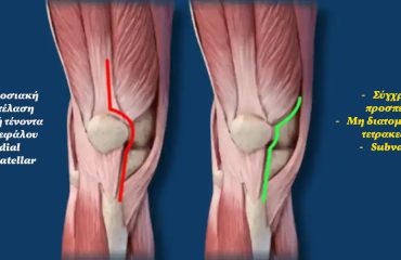 Subvastus approach for knee arthroplasty Προσπέλαση υπό τον έσω πλατύ για αρθροπλαστική γόνατος