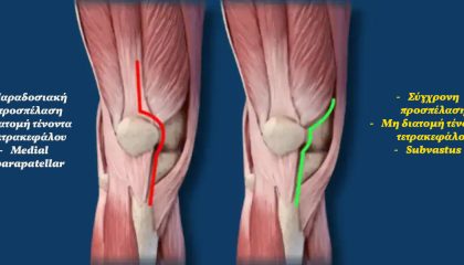 Προσπέλαση υπό τον έσω πλατύ για αρθροπλαστική γόνατος